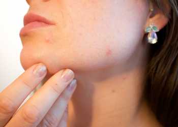 How to Get Rid of Pimples?