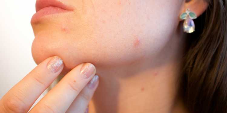 How to Get Rid of Pimples?