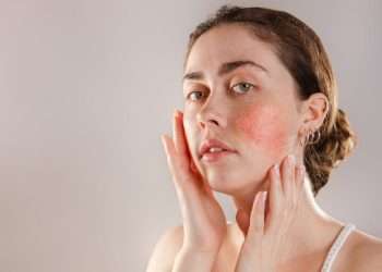 How to prevent your eczema from flaring up