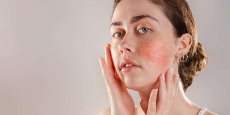 How to prevent your eczema from flaring up