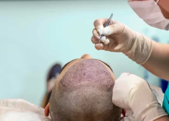 Understanding FUE Hair Transplant Pricing in Australia