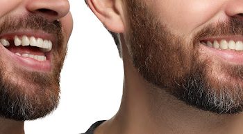 Brisbane’s Trusted Dental Implant Solution: Sandgate Bayside Dental Can Transform Your Smile